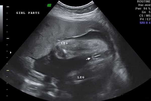 1分钟让你明白5天囊胚整个成功着床过程，附清晰图片